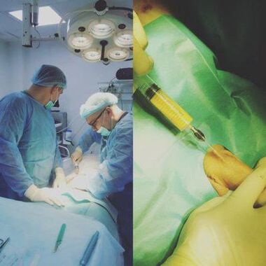 Η πάχυνση του πέους είναι δυνατή με τη βοήθεια χειρουργικής επέμβασης